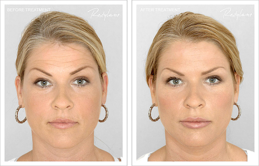 Restylane before & after