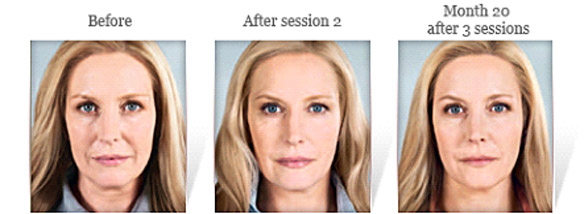 Sculptra® Aesthetic before & after