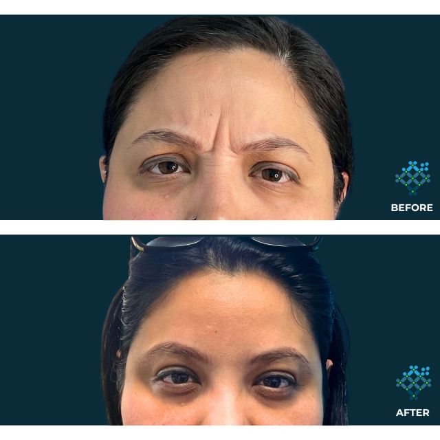 Behold the power of Botox! Swipe to witness the stunning before and after transformation🤩👏

And here's the cherry on top: Join our VIP program and enjoy 15% off on Botox and Fillers for a more radiant you! 🌟

#RejuvimeVIP #BotoxBeforeAndAfter #AgelessBeauty #TransformationTuesday #Rejuvime #botoxfiller #wrinkles #filler #byebye #byebyewrinklesandfinelines #BotoxBeforeAndAfter #BotoxTransformation #BotoxResults #BotoxJourney  #BotoxBeauty #BotoxMagic #BotoxEffect #BotoxFix #WrinkleFree #SmoothSkin #YouthfulGlow #AntiAging